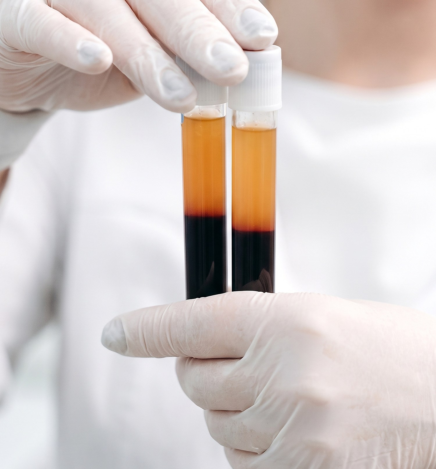 Separated blood samples held in gloved hands during comprehensive lab testing at Citrin Longevity in West Hollywood, Los Angeles